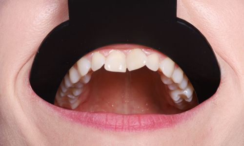 Dokumentacja fotograficzna zębów. Kontrastor do zębów zgryzowych szerokość 51 mm