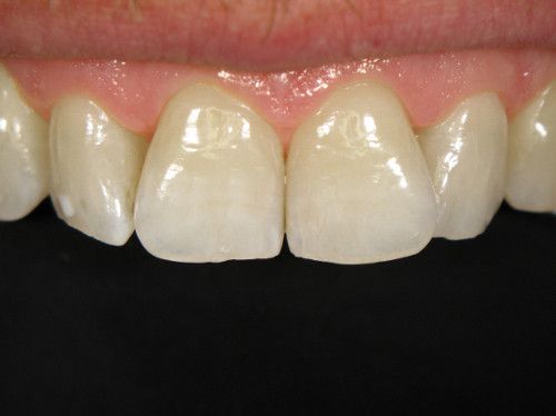 Dokumentacja fotograficzna zębów. Kontrastor do zębów przednich szerokość 65 mm